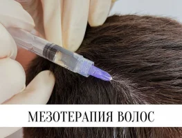 Мезотерапия волос 